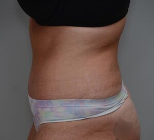 Abdominoplasty Before & After Patient #1496