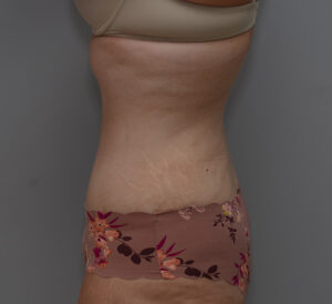 Abdominoplasty Before & After Patient #1495