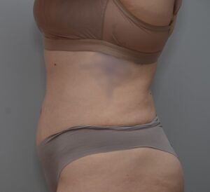 Abdominoplasty Before & After Patient #1494