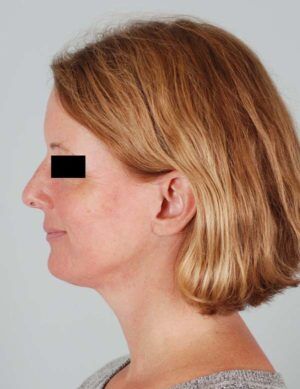 Face And Neck Lift Before & After Patient #1743