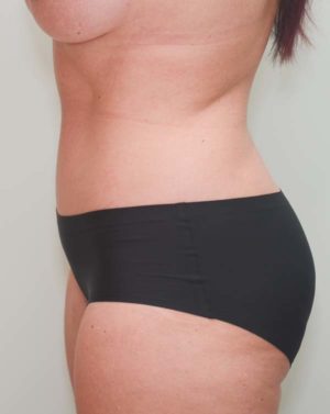 Abdominoplasty Before & After Patient #1326