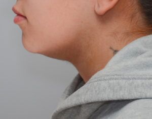 Neck Liposuction Before & After Patient #2006