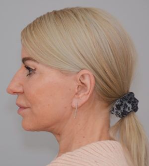 Face And Neck Lift Before & After Patient #1745