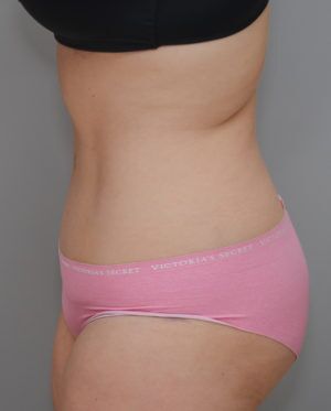 Abdominoplasty Before & After Patient #1271