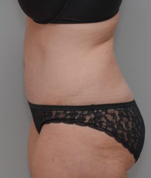 Abdominoplasty Before & After Patient #1387