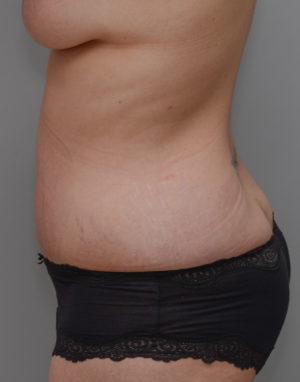 Abdominoplasty Before & After Patient #1440