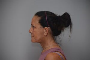 Face And Neck Lift Before & After Patient #1744