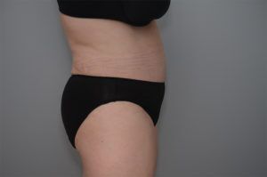 Abdominoplasty Before & After Patient #1210