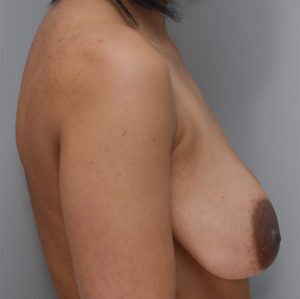 Breast Lift Before & After Patient #900