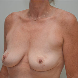 Breast Augmentation Before & After Patient #247