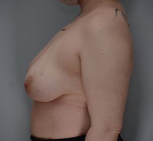 Breast Reduction Before & After Patient #1131