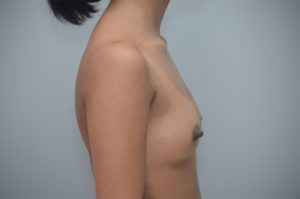 Breast Augmentation Before & After Patient #248