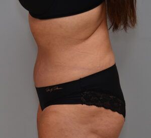 Abdominoplasty Before & After Patient #1443