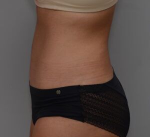 Abdominoplasty Before & After Patient #1442