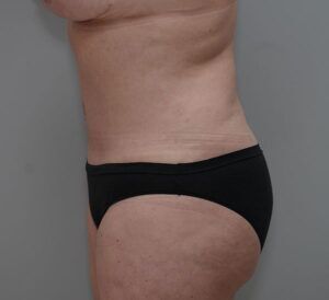 Abdominoplasty Before & After Patient #1444