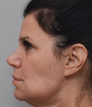 Laser Skin Resurfacing Before & After Patient #2230