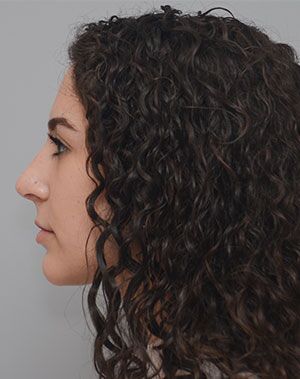 Rhinoplasty Before & After Patient #2114