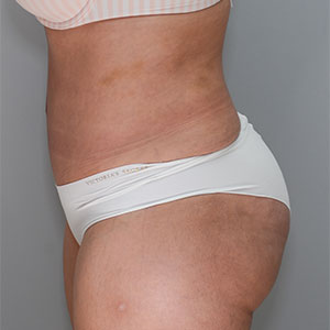 Abdominoplasty Before & After Patient #1329