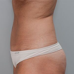 Abdominoplasty Before & After Patient #1328