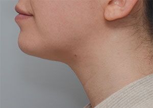 Neck Liposuction Before & After Patient #1950