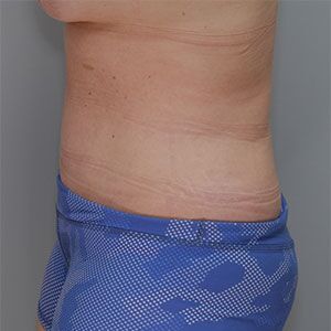 Abdominoplasty Before & After Patient #1272