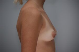 Breast Augmentation Before & After Patient #301