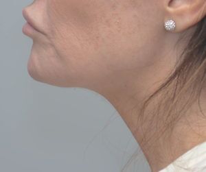 Neck Liposuction Before & After Patient #2003