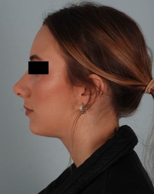 Rhinoplasty Before & After Patient #2113