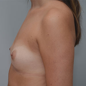 Breast Augmentation Before & After Patient #358