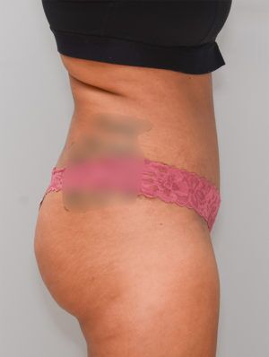 Abdominoplasty Before & After Patient #1269