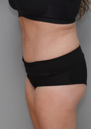 Abdominoplasty Before & After Patient #1211