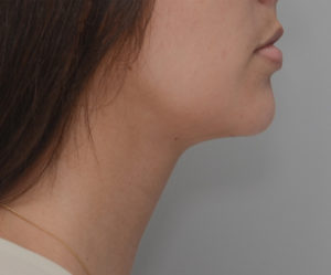 Neck Liposuction Before & After Patient #1948