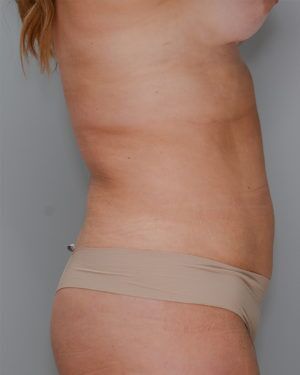 Bodytite Before & After Patient #1557
