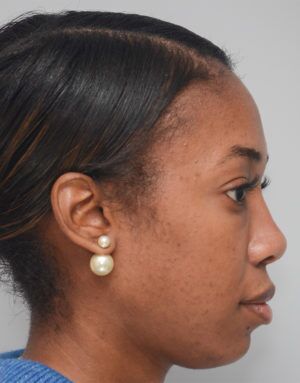 Non-Surgical Rhinoplasty Before & After Patient #2248