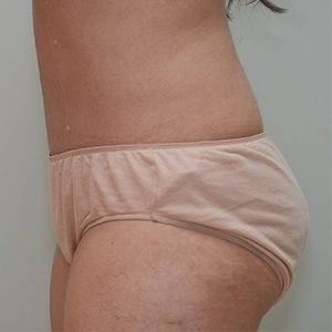 Abdominoplasty Before & After Patient #1208