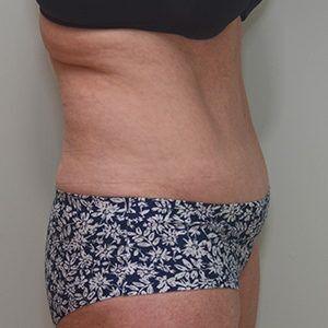 Abdominoplasty Before & After Patient #1209