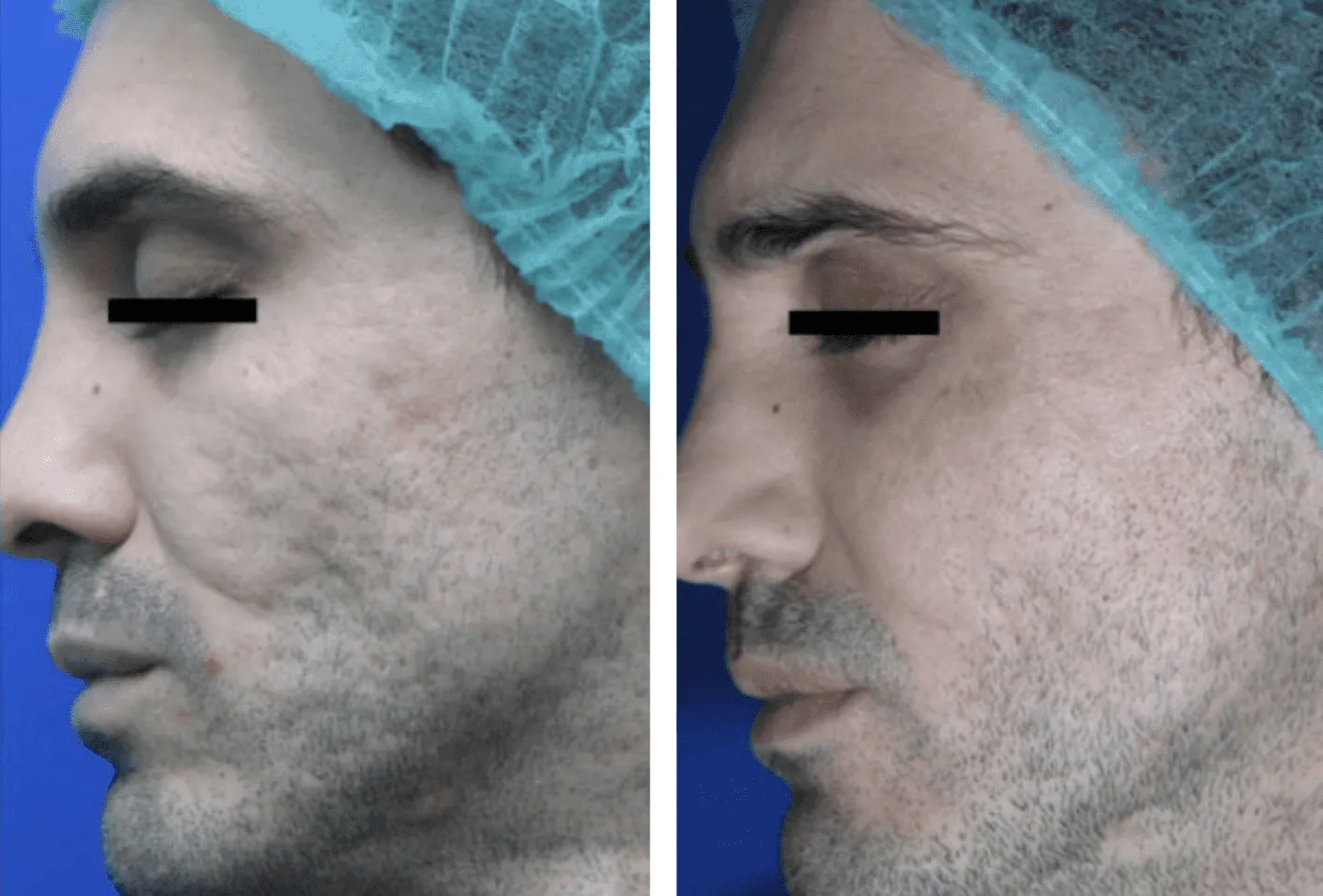 The Benefits Of CoolPeel Laser Resurfacing Treatment Make It Worthwhile ...