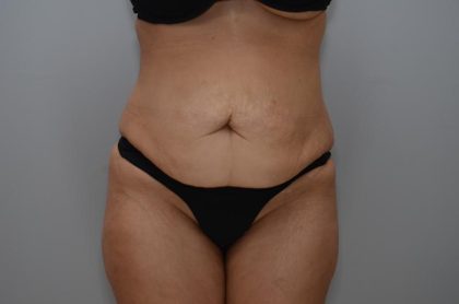 Abdominoplasty Before & After Patient #3158