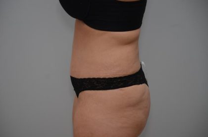 Abdominoplasty Before & After Patient #3158