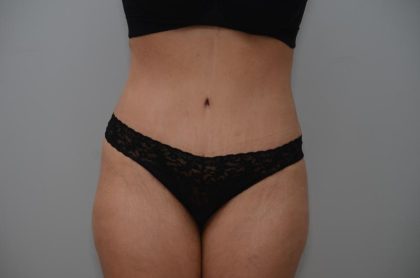 Abdominoplasty Before & After Patient #3158