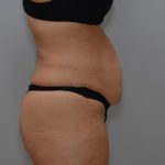 Abdominoplasty Before & After Patient #3158