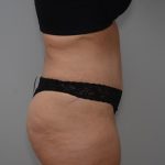 Abdominoplasty Before & After Patient #3158