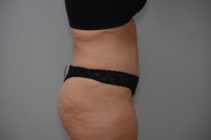 Abdominoplasty Before & After Patient #3158