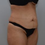 Abdominoplasty Before & After Patient #3158