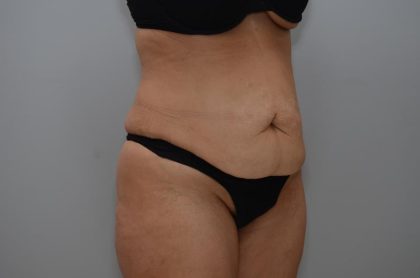 Abdominoplasty Before & After Patient #3158