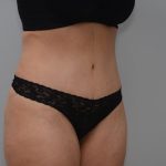 Abdominoplasty Before & After Patient #3158