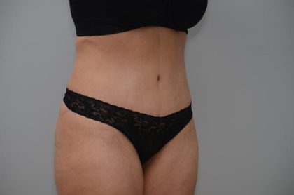 Abdominoplasty Before & After Patient #3158