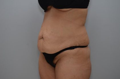 Abdominoplasty Before & After Patient #3158