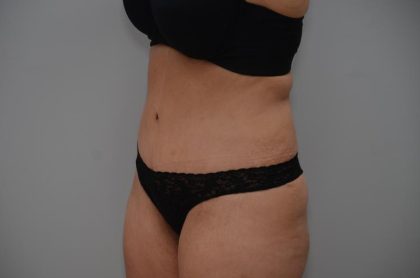 Abdominoplasty Before & After Patient #3158