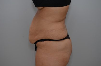 Abdominoplasty Before & After Patient #3158